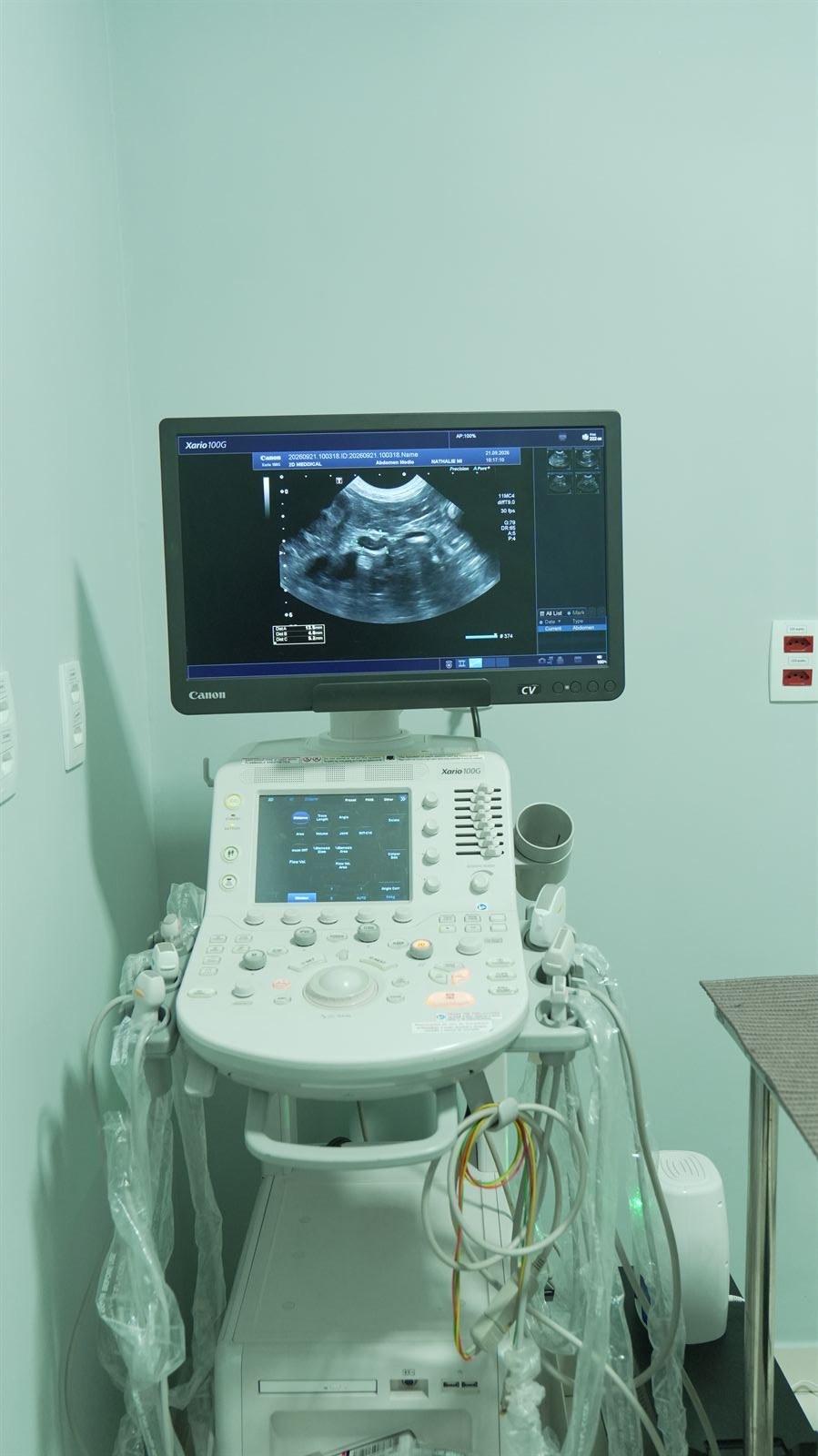 Aparelho de ultrassonografia com imagem no monitor